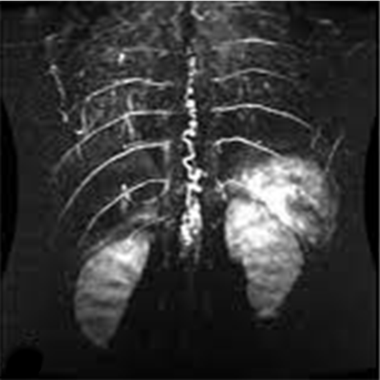 MR Angiography Spinal